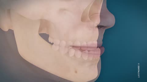 Avancée maxillaire