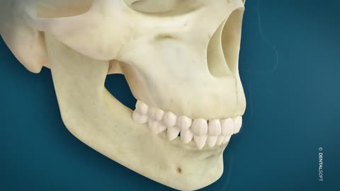 Impaction maxillaire