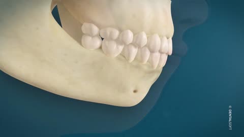 Mentoplastie
